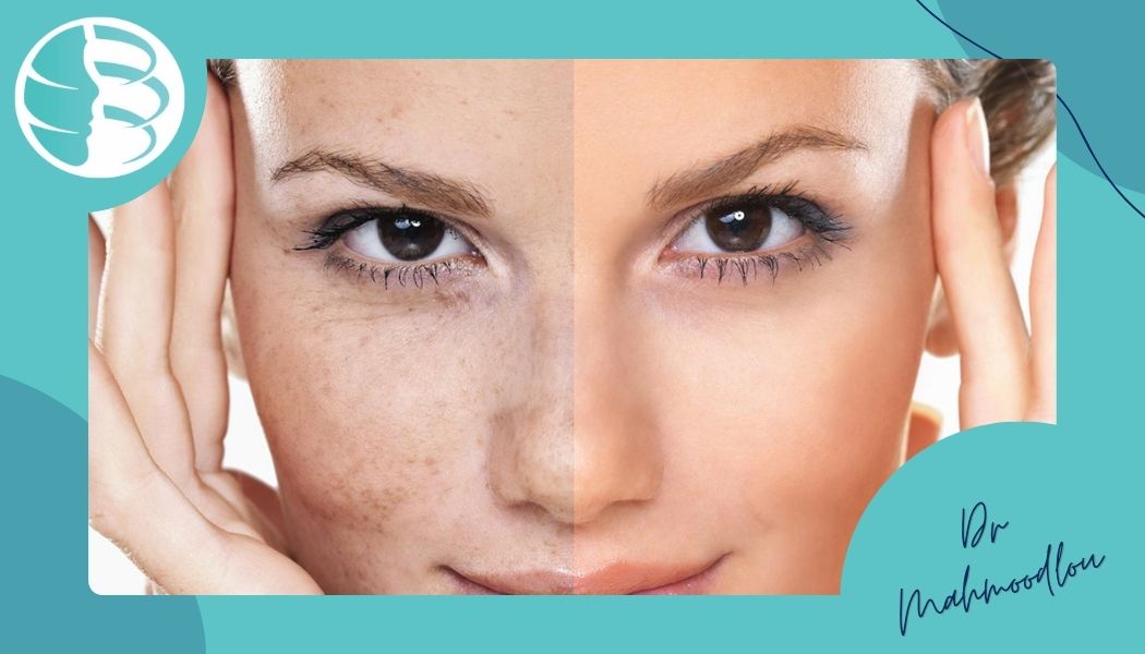 عوارض بعد از تزریق ژل اس وی اف 