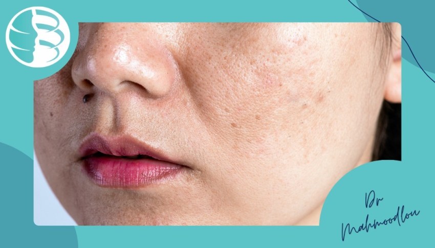 چرا لک و تیرگیهای پوستی ایجاد میشوند؟ چرا لک و تیرگیهای پوستی ایجاد میشوند؟