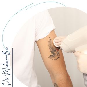 نکات مهم قبل از محو کردن تتو