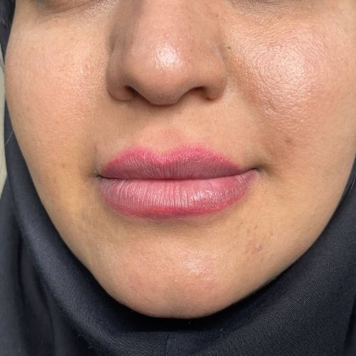 فیلر لب