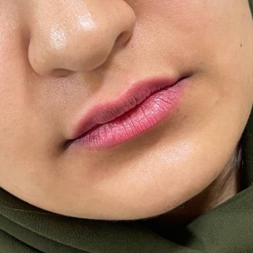 فیلر لب