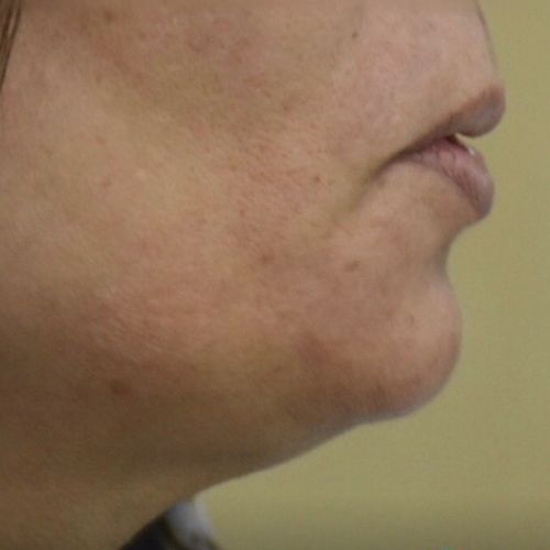 رفع غبغب رفع غبغب