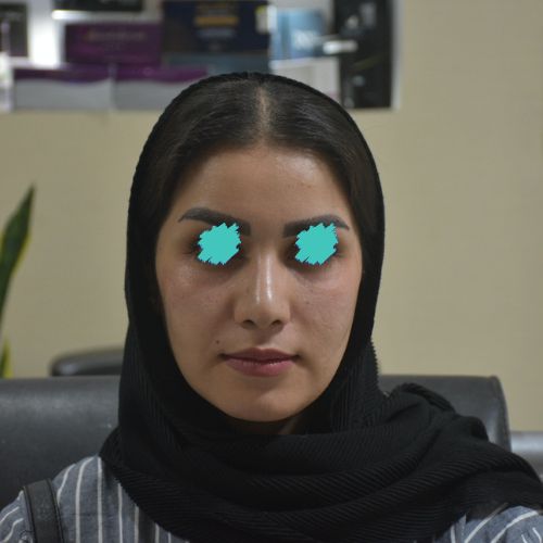 فیلرزیر چشم فیلرزیر چشم