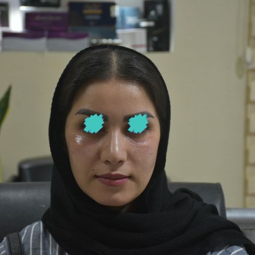 فیلرزیر چشم فیلرزیر چشم