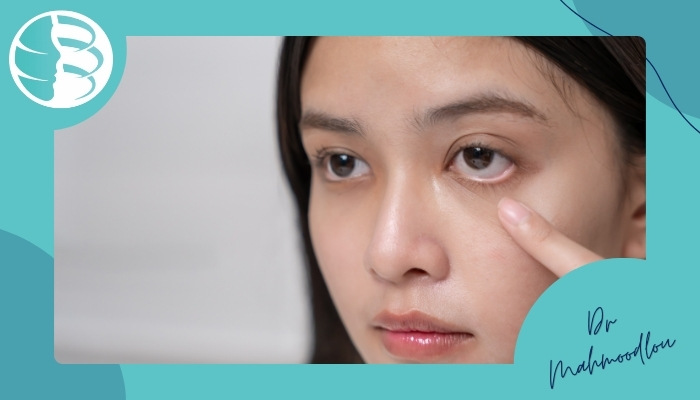 افراد مستعد گودی چشم بعد از جراحی پلک افراد مستعد گودی چشم بعد از جراحی پلک