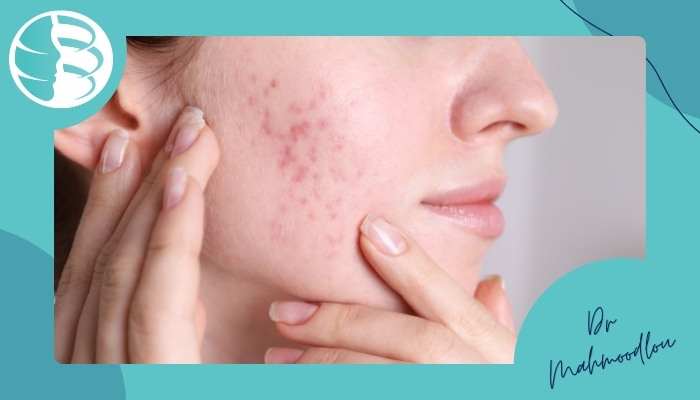 انواع اسکار جوش و لک‌های پوستی