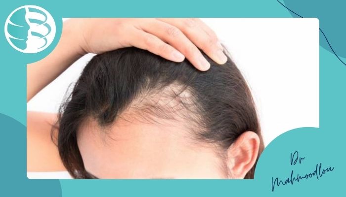 کاربردهای درمانی روش GFC در کنترل ریزش مو