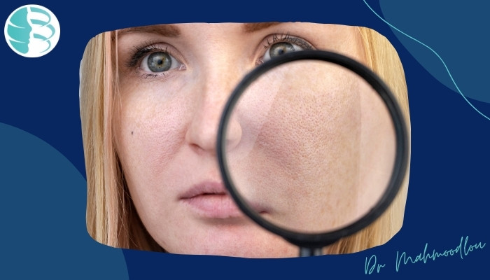 درمان منافذ باز پوست صورت با چه روشی موثرتر است؟