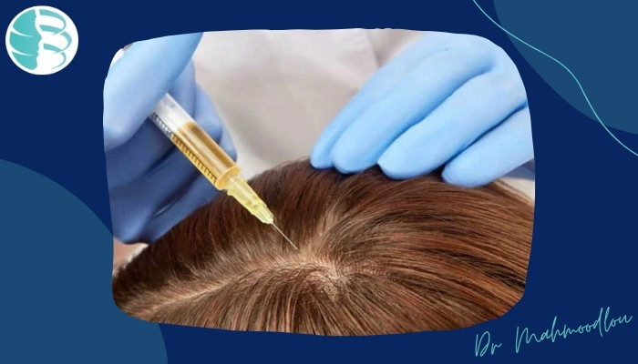 روش SVF مو بهترین روش تقویت و درمان ریزش مو