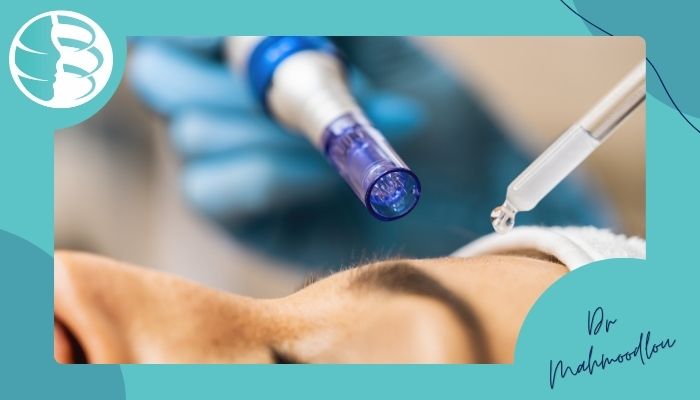 روش انجام میکرونیدلینگ روش انجام میکرونیدلینگ