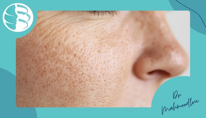 روش‌های درمان منافذ باز پوست صورت