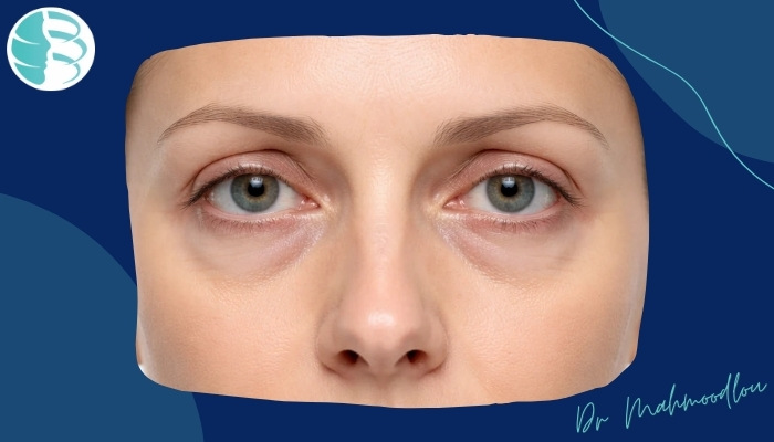 علت گود شدن چشم بعد از بلفاروپلاستی در بعضی افراد چیست؟ علت گود شدن چشم بعد از بلفاروپلاستی در بعضی افراد چیست؟