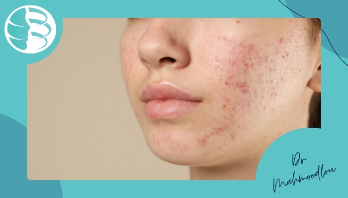 عوامل موثر در ماندگاری عارضه‌های پوستی