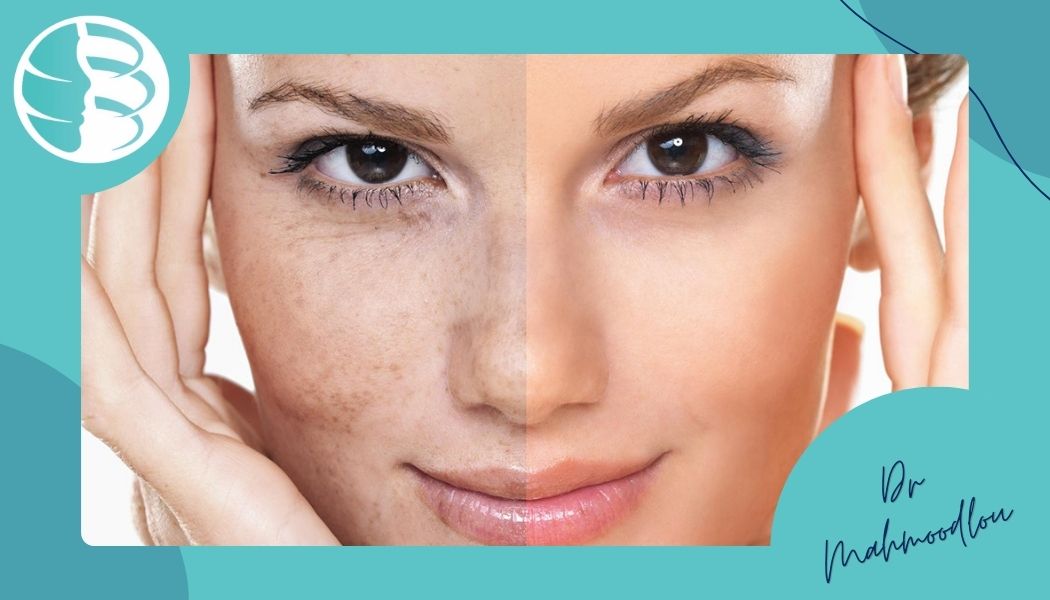 باورهای نادرست درباره مزوژل