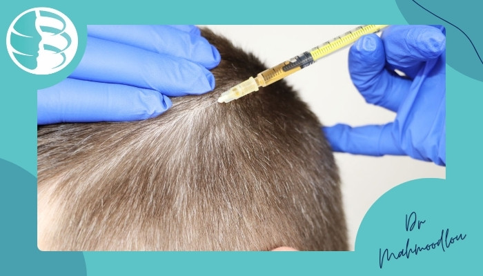 نحوه درمان ریزش مو با ACS نحوه درمان ریزش مو با ACS