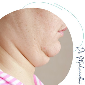 هزینه‌های حذف غبغب