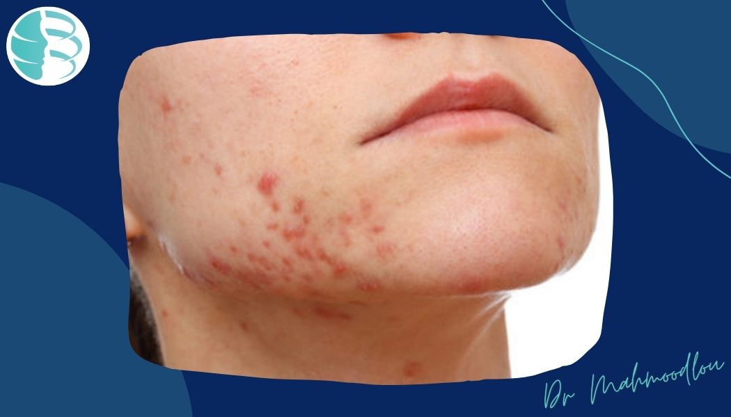 چگونه جای جوش را از بین ببریم؟ نکاتی که باید بدانید