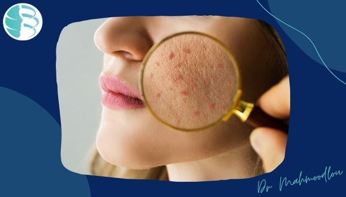 چگونه می‌توان جای جوش و لکه‌های قدیمی پوست را از بین برد؟