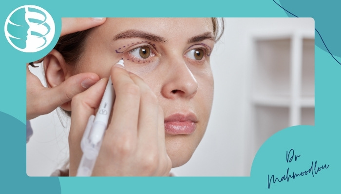 گود شدن چشم بعد از بلفاروپلاستی گود شدن چشم بعد از بلفاروپلاستی